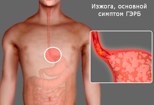 Как снять воспаление пищевода в домашних условиях
