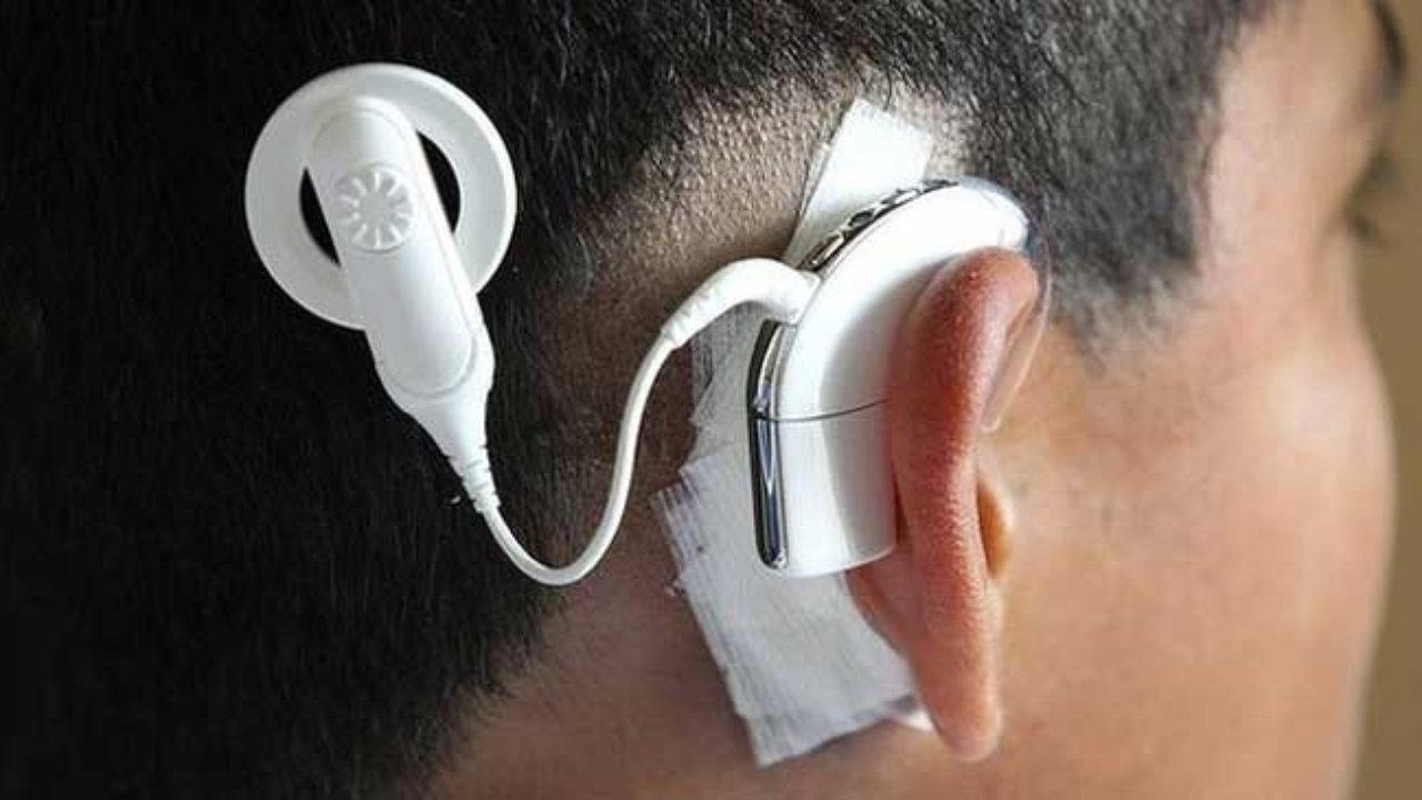 Протез уха. Аппарат Cochlear кохлеарный. Кохлеарный имплант кохлеар. Advanced Bionics слуховой аппарат. Аппарат для глухих кохлеарная имплантация операция.