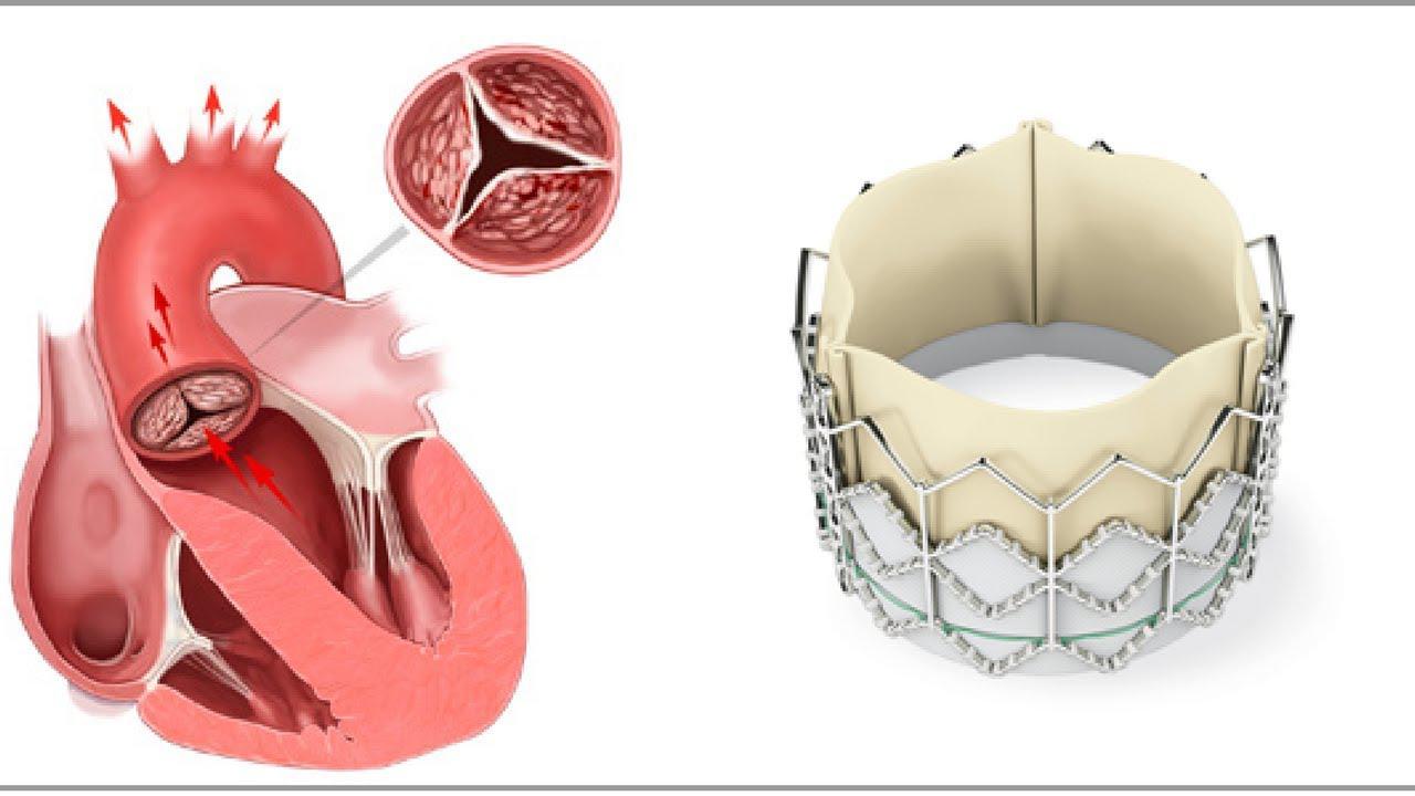 Митральный клапан после операции. Митральный и аортальный клапан сердца. Эндопротезирование аортального клапана. Механический протез аортального клапана. Аортальный клапан сердца протез.